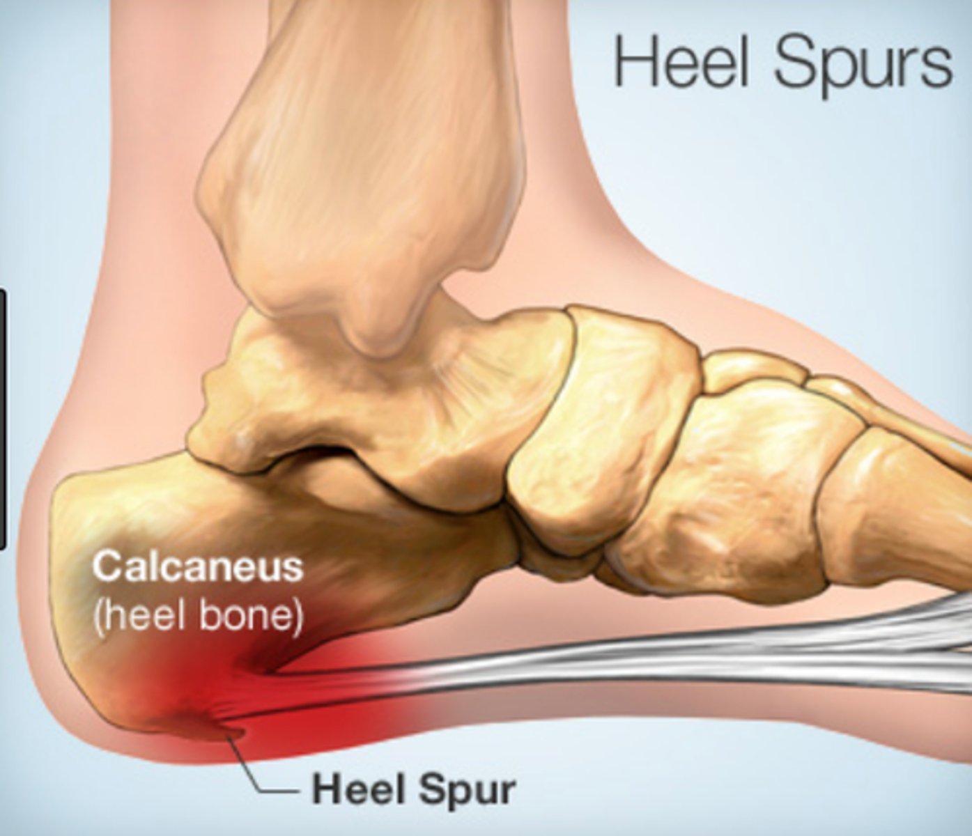 <p>calcium deposit in the plantar fascia</p>