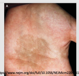 <p>Tinea nigra-dark brown to black discolorations on the palm occurring more commonly in warm coastal regions among young women</p>