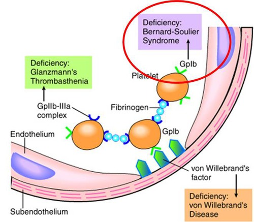 <p><em>Defect in Platelet Adhesion</em></p><ul><li><p><strong>Primary defect</strong>: <strong>Absent or dysfunctional glycoprotein Ib (GPIb)</strong> on platelet surface</p></li><li><p><strong>Mechanism</strong>: Platelets <strong>cannot bind von Willebrand factor (vWF)</strong> → impaired adhesion to subendothelium</p></li><li><p><strong>Lab findings</strong>:</p><ul><li><p><strong>↑ Bleeding time/PFA</strong></p></li><li><p><strong>↓ Platelet count</strong>, <strong>large platelets</strong></p></li><li><p><strong>Normal aggregation</strong> with all agents <strong>except ristocetin</strong></p></li></ul></li></ul><p></p>