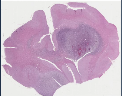 <p>name this tumor</p>