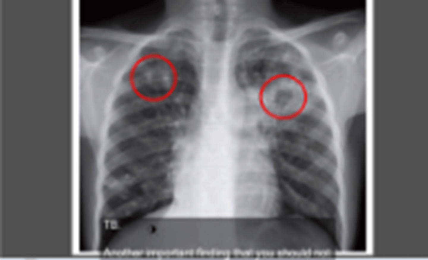 <p>lung cancer</p>