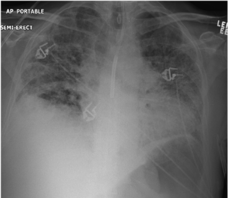 <p>Is this a good placement for a NGT (feeding) tube? Why or why not?</p>