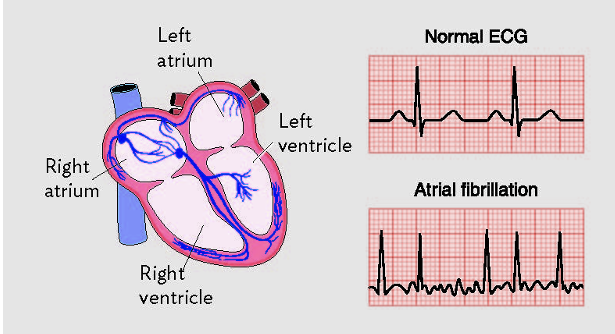 <p>Atrial fibrillation is the <strong>most common type of tachycardia</strong></p><ul><li><p>can result from <strong>atrial flutter</strong></p></li><li><p>atrial muscles <strong>cannot effectively contract</strong></p></li><li><p><strong>AV node can’t keep pace</strong> with speed of atrial contractions but some stimulation is passed on</p></li><li><p>only r<u>educed cardiac output by 15%</u></p></li><li><p>associated with <u>increased risk of thrombi, stroke, and heart failure</u></p></li></ul><p></p>