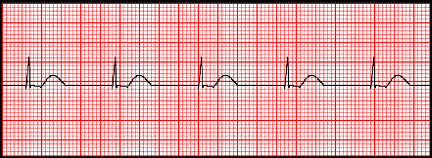 <p>-absence of P waves or possibly retrograde P waves </p><p>-narrow QRS </p><p>-40-60bpm (AV NODE ORIGIN)</p>