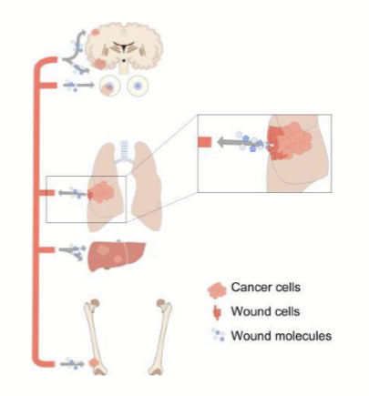 <ul><li><p>Breast</p></li><li><p>Lung</p></li><li><p>Prostate</p></li><li><p>Lymphoma (with leukemia presentations) </p></li></ul><p></p>