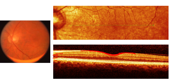 <p>permits a non-invasive imaging through the depth of the retina</p><ul><li><p>usually the side view photo not the one of the fundus</p></li></ul><p></p>