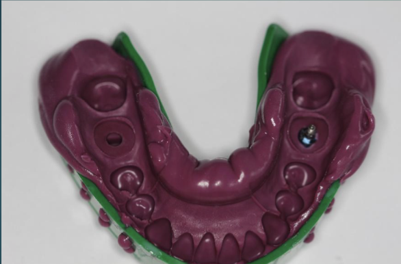 <ul><li><p>make sure the impression coping is fully embedded in the impression material </p></li><li><p>no voids in the impression </p></li><li><p>all important details must be included in the impression </p></li></ul><p></p>