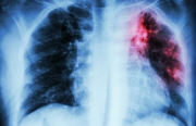 Lung Cancer (Lung Carcinoma)