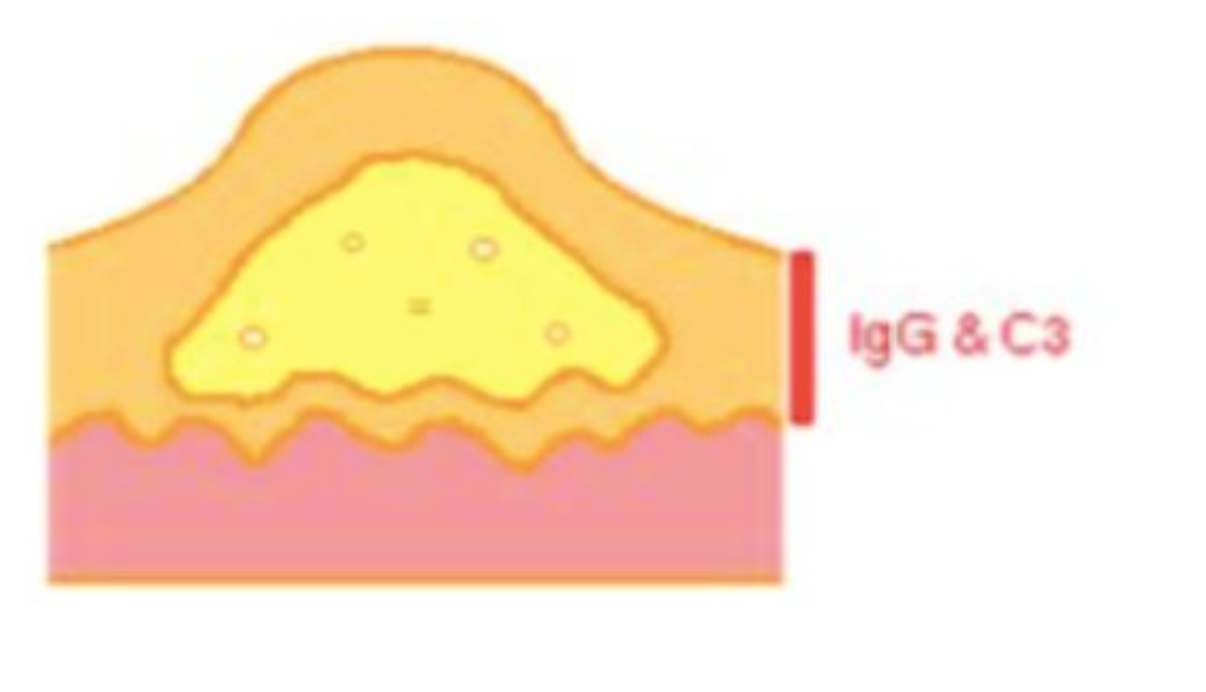 <p>Which disease: blister within the epidermis; floor lined by basal csel acantholytic slcel ni blister fluid; intercellular igG &amp;C3 by direct immunofluorescence</p>