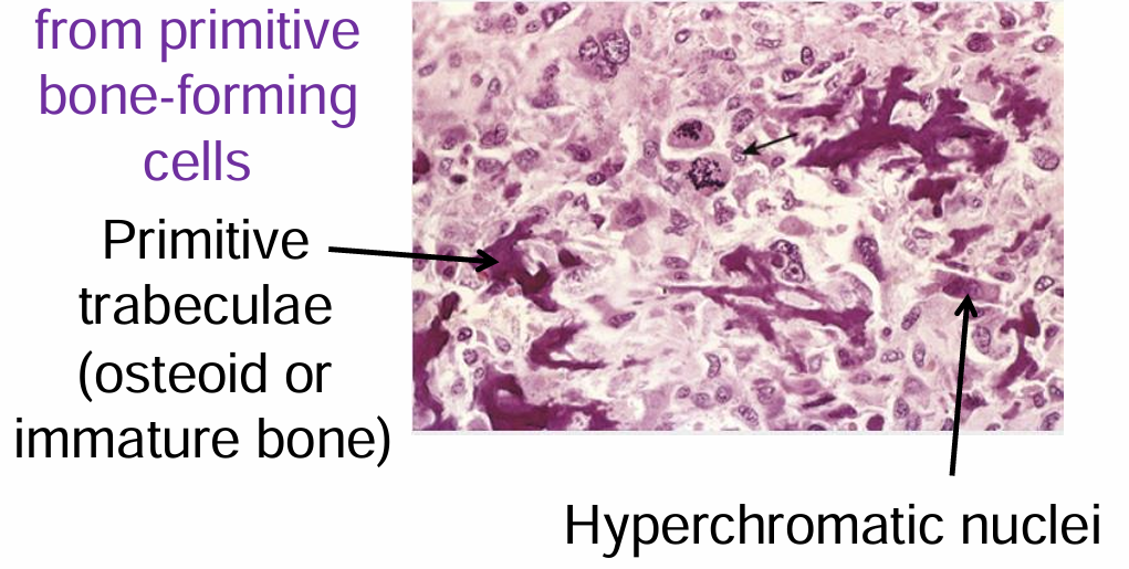 <ul><li><p>Primitive trabeculae (Osteoid or Immature bone)</p><ul><li><p>Thought to arise from primitive bone-forming cells</p></li></ul></li><li><p>Hyperchromatic nuclei</p></li></ul><p></p>