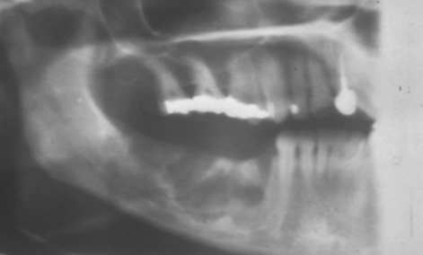 <p>well circumscribed or ill defined </p>