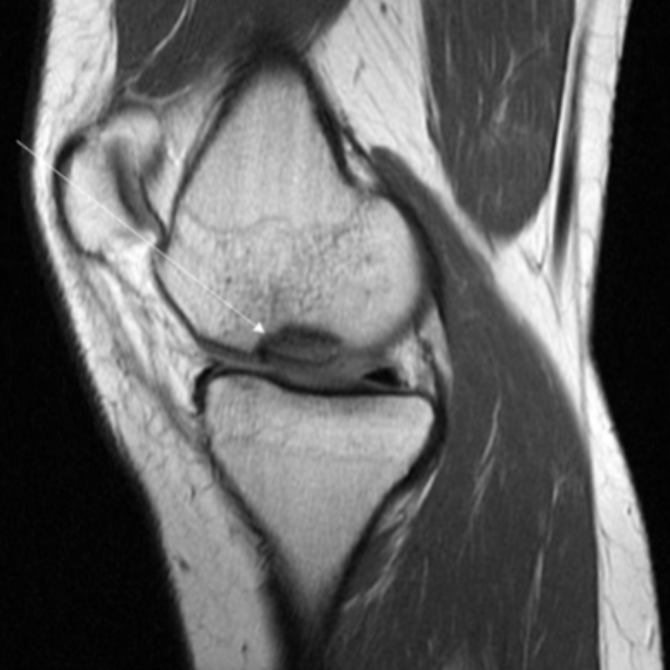 <p>Describe the pathology indicated by the arrow (Sag PD). </p>
