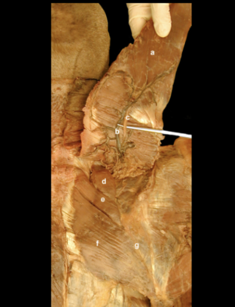 <p>Identify the Spinal Accessory nerve &amp; Transverse Cervical Artery</p>