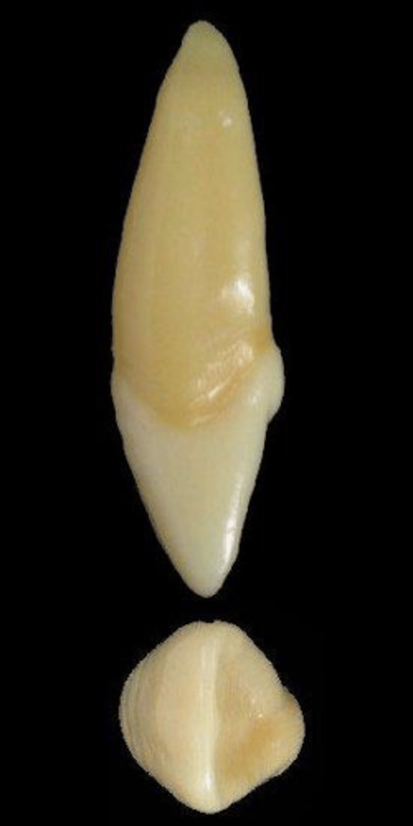 <p>what tooth is this &amp; why?</p>