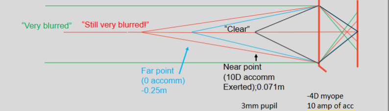 <p>myopia of -4.00 with 10D accom</p>