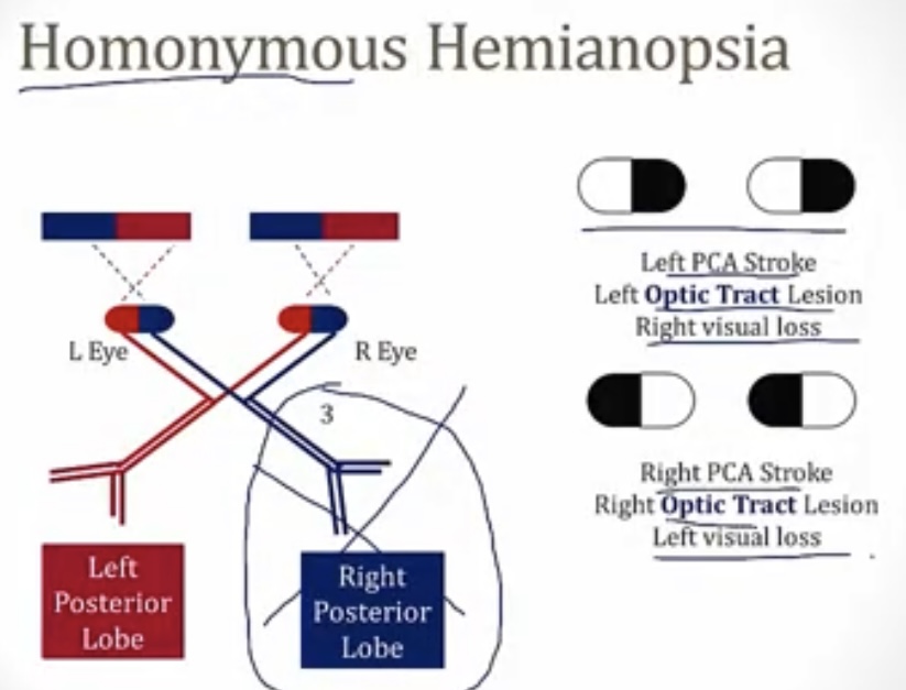 <p>-loss of vision of either the left field in both eyes, or the right field in both eyes</p><p>-LEFT PCA stroke; LEFT optic tract lesion</p><p>-RIGHT PCA stroke; RIGHT optic tract lesion</p>