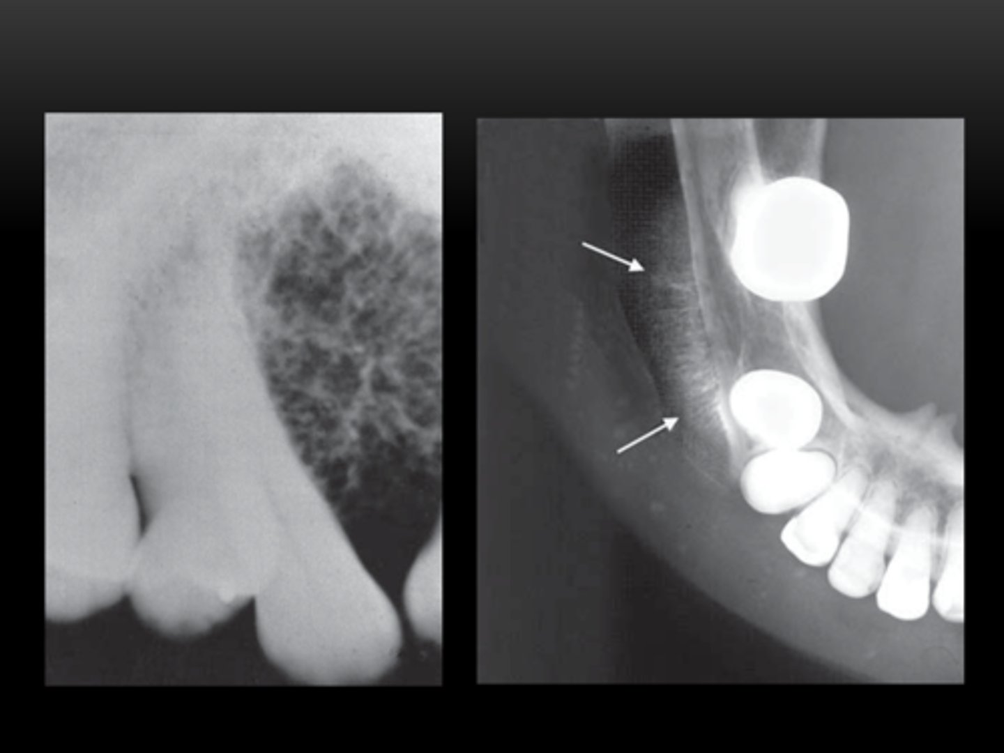 <p>RL/mixed</p><p>variable margins</p><p>"multilocular"</p><p>root resorption</p><p>canal widening</p>