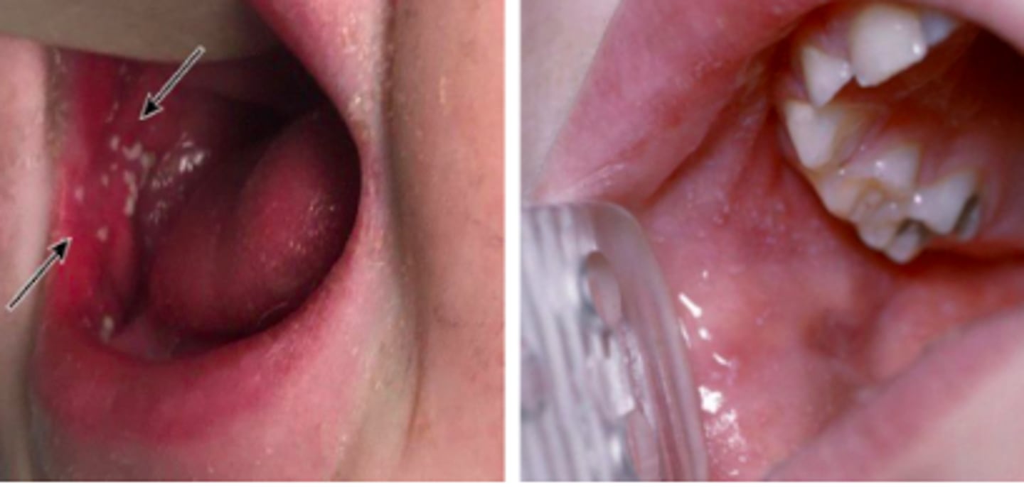 <p>Exanthems:</p><p>Objective:</p><p>Koplik spots - small whitish, grayish, bluish elevations with erythematous base</p><p>- Typically seen more on buccal mucosa opposite the molar teeth</p><p>- Described as “grains of salt on a red background”</p><p>- Last 12-72 hours</p><p>- Slough when exanthem appears</p><p>Rash:</p><p>- Erythematous, maculopapular, blanching</p><p>- May include petechiae later that will not blanch</p><p>- Cranial → caudal progression</p><p>- Usually spares palms/soles</p><p>- Lymphadenopathy, high fever, pharyngitis, nonpurulent conjunctivitis</p>