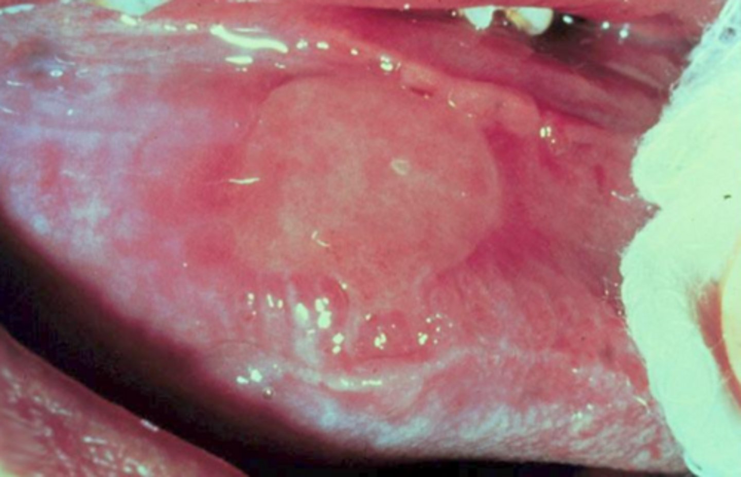 <p>pemphigus vulgaris</p>
