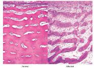 <p>Gross:</p><ul><li><p>marked joint hypermobility causes inability to stand</p></li><li><p>dentinogenesis imperfecta</p></li><li><p>normal shape bones but very brittle</p></li></ul><p>Histo:</p><ul><li><p>variable osteoblast numbers and activity</p></li><li><p>calcified cartilage spicules in primary spongiosa lined by very thin layer of basophilic bone matrix</p></li><li><p>little osteoclastic resorption or trabecular realignment. woven bone may line deeper secondary spongiosa</p></li></ul><p>caused by collagen chain mutations in goldies and beagles (COL1A1 and COL1A2)</p><p>autosomal recessive mutation of SERPINH1 in dachshunds of collagen chaperone HSP47</p><p>Breed predisposition: holstein-friesians, charolais, angus, Romney lambs, the dog breeds mentioned above </p><p></p>