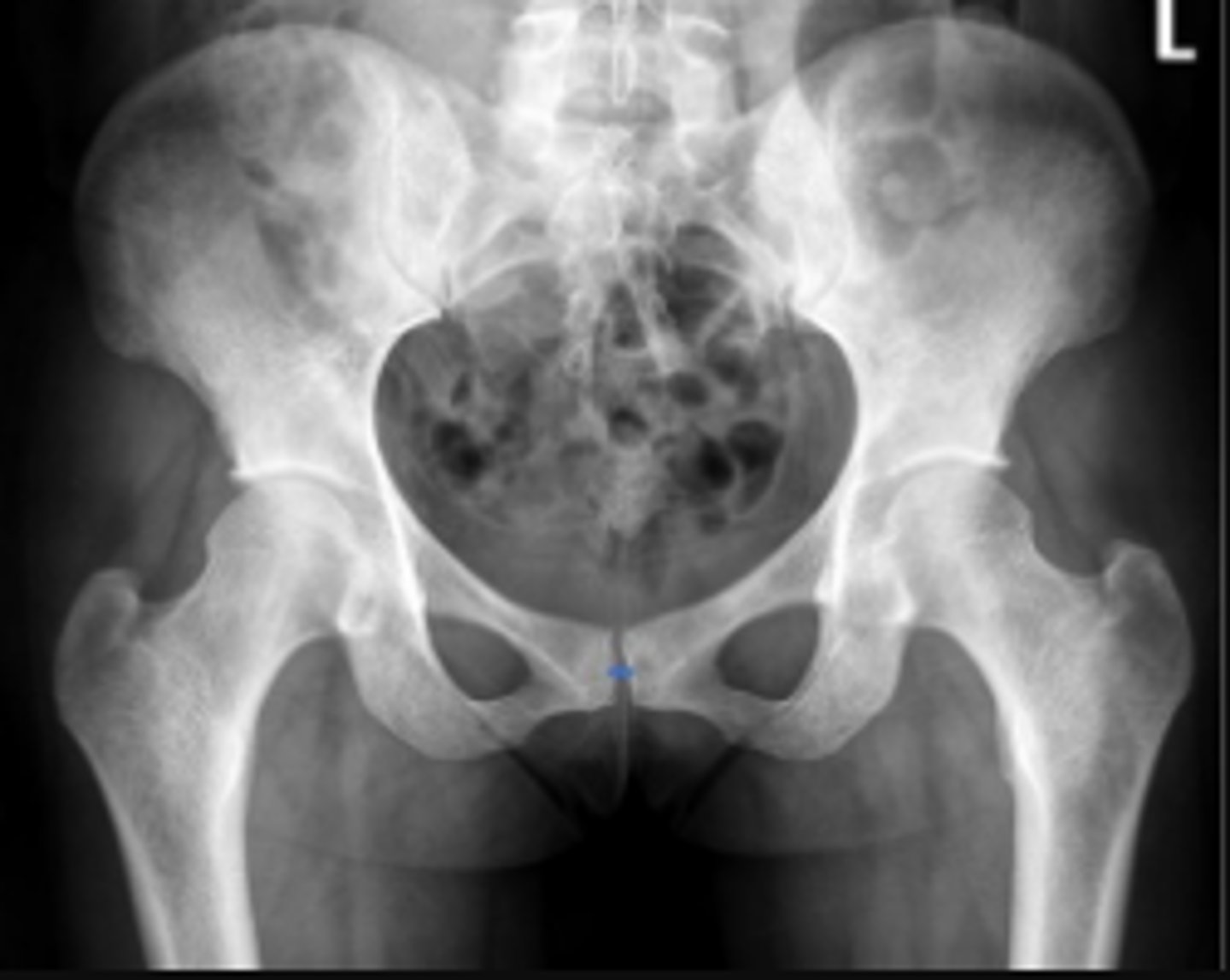 <p>What are the osseous landmarks for this assessment?</p>