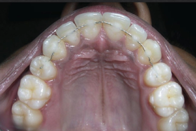 <p>mechanical stabilization of teeth&nbsp;</p>