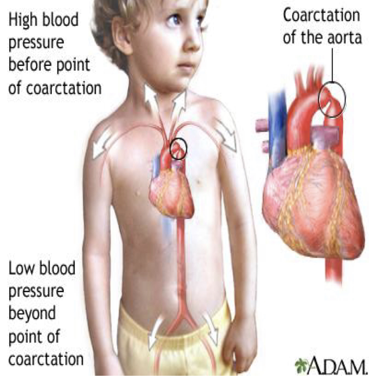 <p>increased resistance to blood flow to body</p><p>left ventricle</p><ul><li><p>elevated pressure to maintain flow</p></li><li><p><strong>proximal </strong>to narrowing: pressures are <strong>high</strong></p></li><li><p><strong>disal </strong>to narrowing: pressures are <strong>low</strong></p></li><li><p>collateral pathways</p></li></ul><p></p><p>presentation</p><ul><li><p>cardiac collapse at birth</p></li><li><p>as a teenager</p></li></ul><p></p><p><strong>overall goal is to prevent end organ damage</strong></p><p></p>