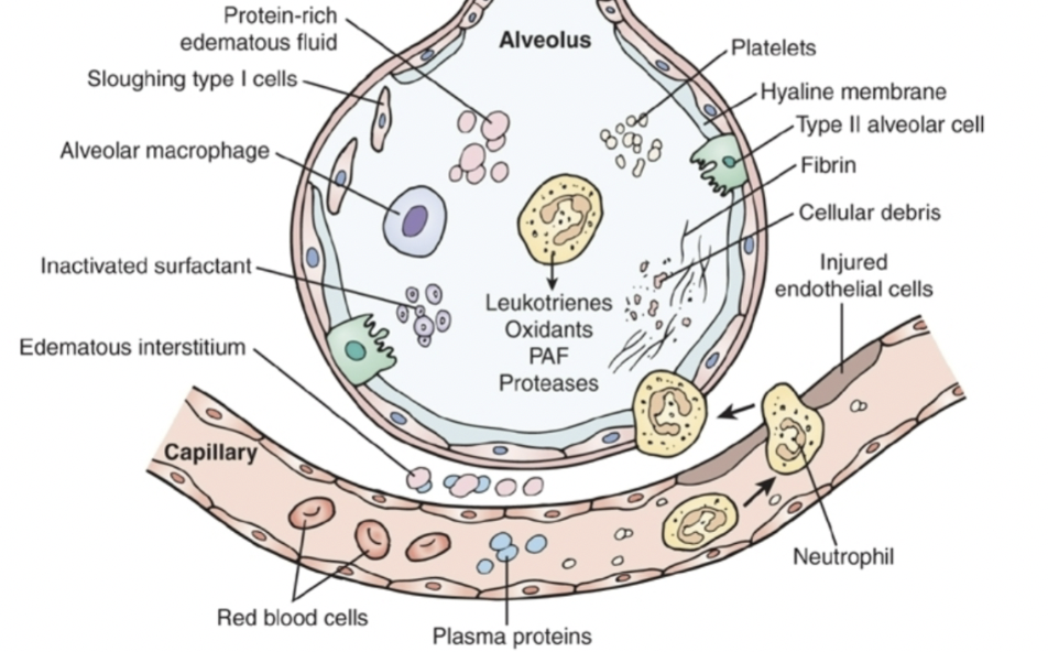 <ul><li><p class="Paragraph SCXW243908321 BCX0" style="text-align: left;"><span style="line-height: 24.4125px;">Neutrophils releasing leukotrienes and proteases&nbsp;&nbsp;</span></p></li></ul><ul><li><p class="Paragraph SCXW243908321 BCX0" style="text-align: left;"><span style="line-height: 24.4125px;">Inactivated surfactant&nbsp;</span></p><ul><li><p class="Paragraph SCXW243908321 BCX0" style="text-align: left;"><span style="line-height: 24.4125px;">Alveoli will collapse&nbsp;</span></p></li></ul></li></ul><ul><li><p class="Paragraph SCXW243908321 BCX0" style="text-align: left;"><span style="line-height: 24.4125px;">Gap formation&nbsp;</span></p><ul><li><p class="Paragraph SCXW243908321 BCX0" style="text-align: left;"><span style="line-height: 24.4125px;">Breakdown in alveolar pathway preventing oxygen from crossing the membrane and reaching the RBCs&nbsp;</span></p></li></ul></li></ul><ul><li><p class="Paragraph SCXW243908321 BCX0" style="text-align: left;"><span style="line-height: 24.4125px;">Have normal, diseased, and collapsed alveoli&nbsp;</span></p></li></ul><ul><li><p class="Paragraph SCXW243908321 BCX0" style="text-align: left;"><span style="line-height: 24.4125px;">Disease throughout the lung and affecting the alveoli&nbsp;</span></p><ul><li><p class="Paragraph SCXW243908321 BCX0" style="text-align: left;"><span style="line-height: 24.4125px;">Have pockets where alveoli works&nbsp;&nbsp;</span></p></li><li><p class="Paragraph SCXW243908321 BCX0" style="text-align: left;"><span style="line-height: 24.4125px;">Adding more PEEP can fix the collapsed alveoli&nbsp;&nbsp;</span></p></li><li><p class="Paragraph SCXW243908321 BCX0" style="text-align: left;"><span style="line-height: 24.4125px;">“recruit alveoli”&nbsp;</span></p></li></ul></li></ul><p></p>