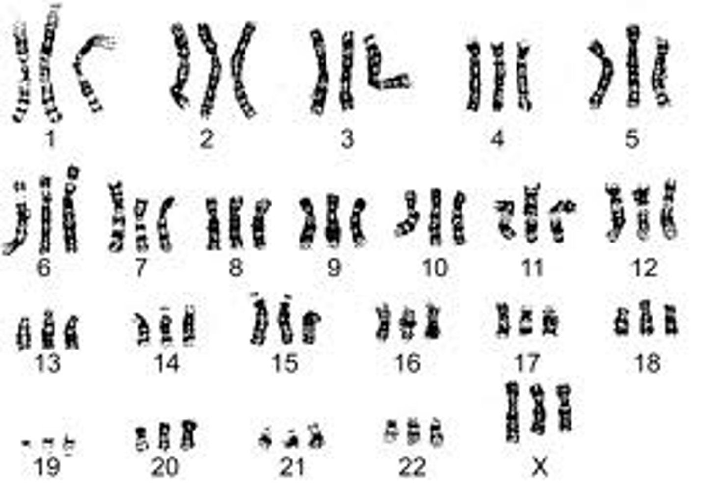 <p>Assoc w/molar pregnancy. Often lethal. Omphalocele, low-setears, IUGR, oligohydramnios, enlarged placenta, heart, GI/GU, CNS,cardiac, facial</p>
