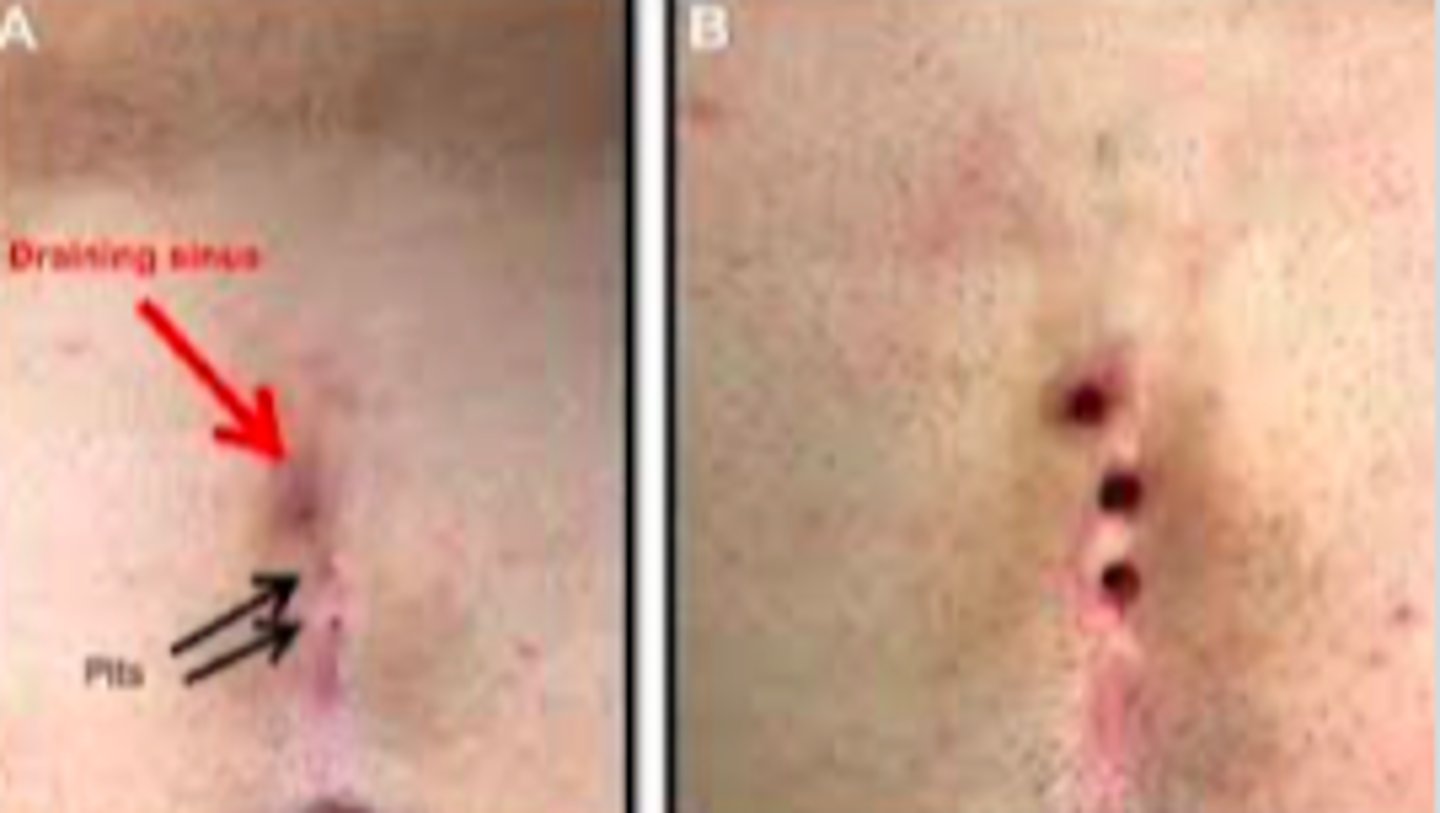 <p>Bacterial ID:</p><p>Identified by retracting buttock cheeks enough to visualize pores or sinuses within natal cleft valley</p><p>- Asymptomatic: 1 or more primary pores in midline and/or painless opening cephalad and slightly lateral to cleft</p><p>Diagnosed clinical based upon findings of characteristic midline pores</p><p>- Acute Exacerbation: cellulitis in natal cleft and tender, fluctuant mass in/near top of natal cleft, slightly lateral, indicating presence of abscess</p><p>- Chronic Disease: 1+ sinus openings draining mucoid, purulent, and/or blood fluid; sometimes can see a hair protruding</p><p>Secondary tracts or pits can be identified lateral to the midline in patients with complex disease</p><p>Diagnose chronic and acute patients by being diagnosed by additional findings of a tender mass and 1+ draining sinus openings</p>