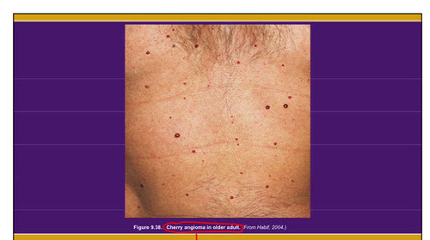 <p>Non-problematic marks on the skin that appear typically after 40</p>