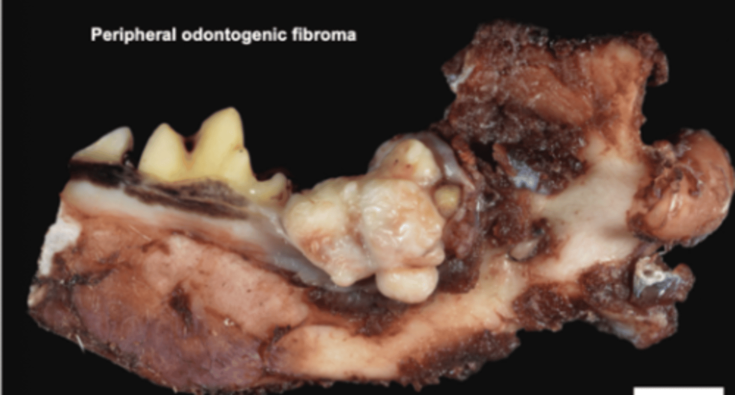 <p>- Fibromatous epulis</p><p>- Can be difficult to distinguish from gingival hyperplasia grossly</p>