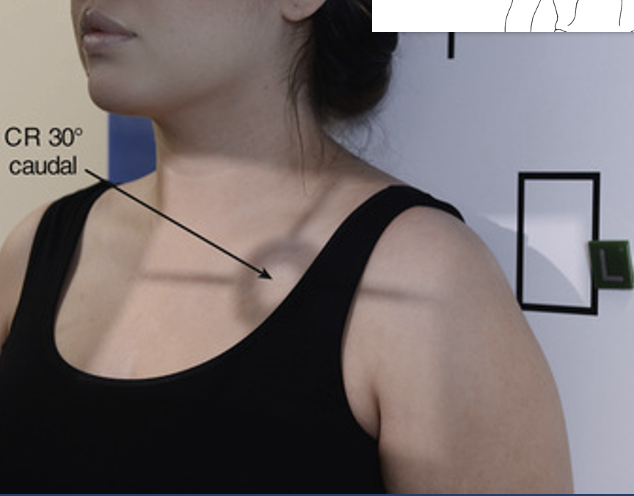 <p>Apical AP axial (shoulder) </p><ul><li><p><span><span>Patient is positioned AP with arm in neutral position</span></span></p></li><li><p><span><span>CR 30° caudal angle (towards feet)</span></span></p></li></ul><p></p>