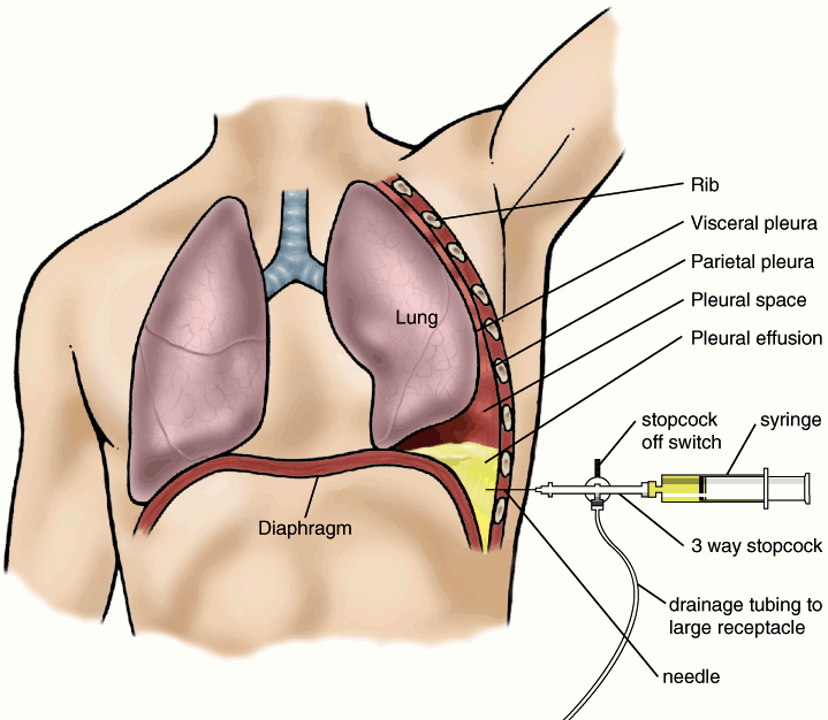 <p>removal of fluid or air from pleural space via transthoracic aspiration</p>