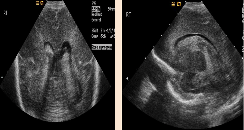 <p>What pathology is being shown?</p>