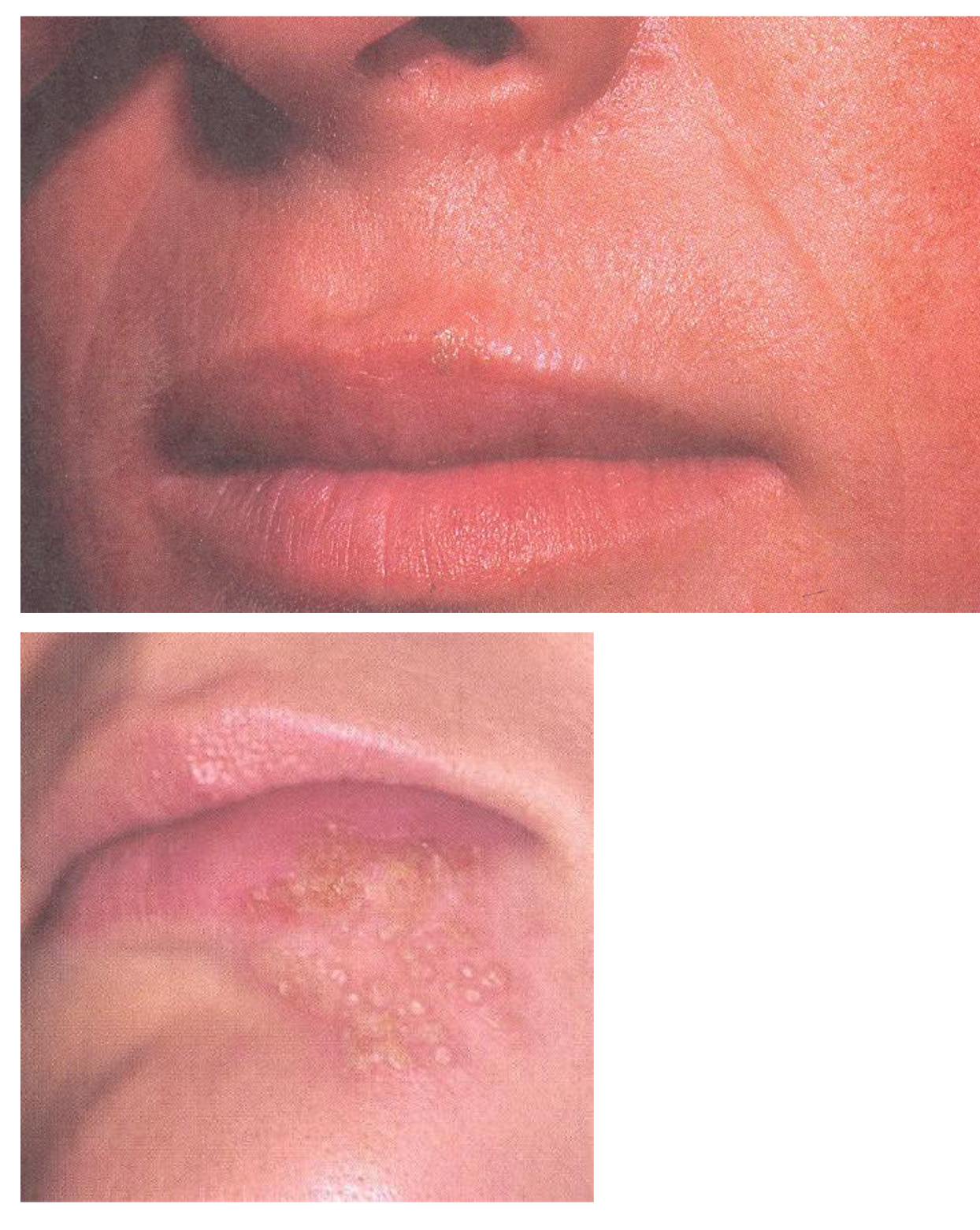 <p>what infection is this caused by?</p>