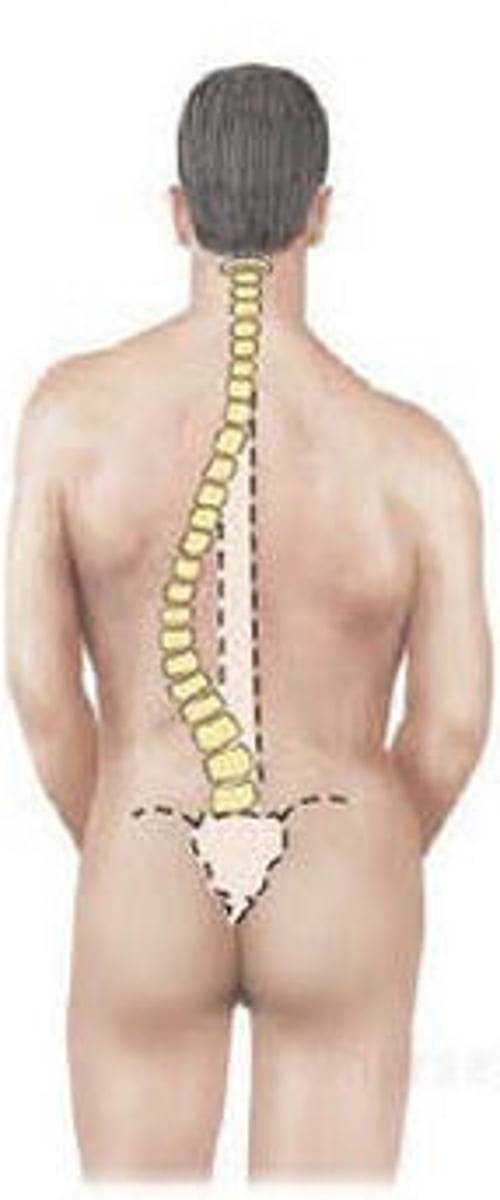 <p>Lateral curvature of the spine.</p>