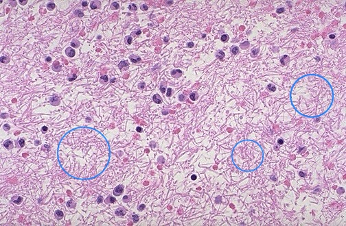 <ol><li><p>Identify encircled structures</p></li><li><p>Are there neutrophils present?</p></li><li><p>Presence of the encircled structure presents what aspect of inflammation?</p></li></ol>