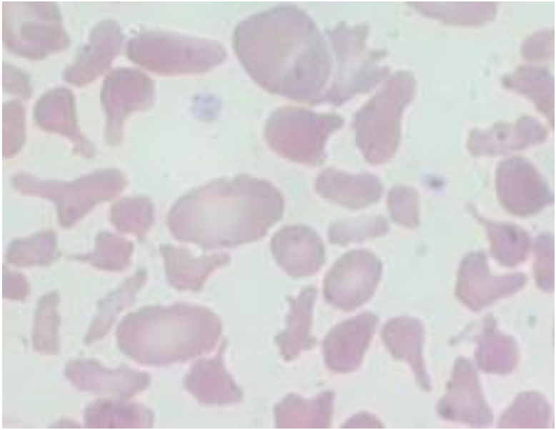 <p><span>Altered cell shape in erythrocytes</span></p>