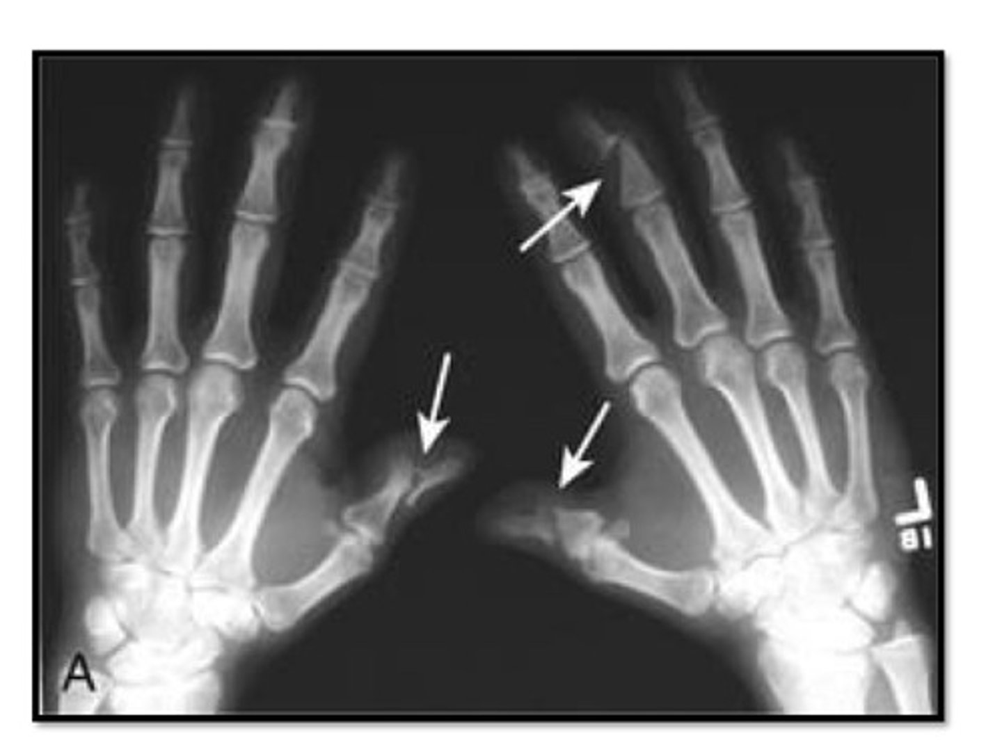 <p>characterized by erosion &amp; new bone formation that may occur in the same joint</p><p>"Pencil in a cup" appearance</p>