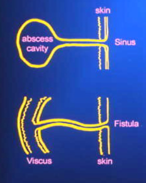 <p>abnormal communication btwn 2 or more structures or spaces</p><p>caused by a dehisced wound or surgical incision</p><p>tx by surgery, NPWT</p><p>drain</p>