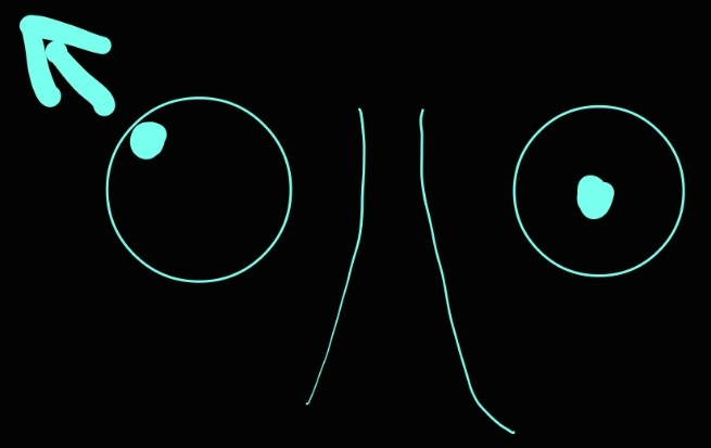 <p>inferior oblique muscle</p>