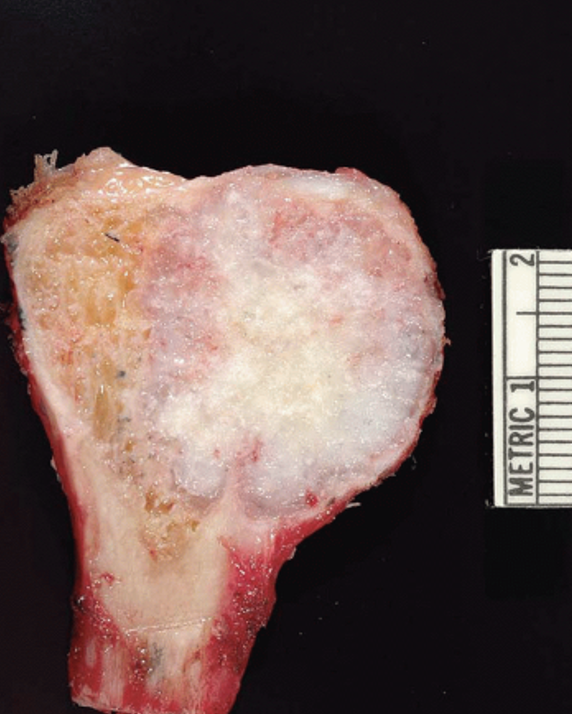 <p><span>Describe the gross appearance.</span></p><p style="text-align: left;"><span>What is the cell of origin?</span></p><p style="text-align: left;"><span>What is the diagnosis?</span></p><p style="text-align: left;"><span>What is the malignant counterpart called?</span></p>