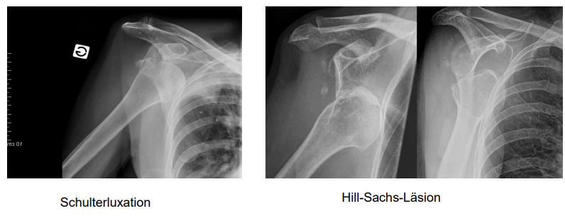 <ul><li><p>Abschlagen, Eindellen des Knochen → Hill-Sachs-Läsion</p></li></ul><p></p>