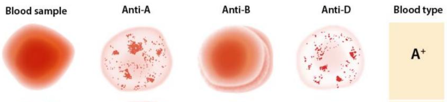 * antibody A and antigen A that cause clumping
* antibody D that cause clumping (+)