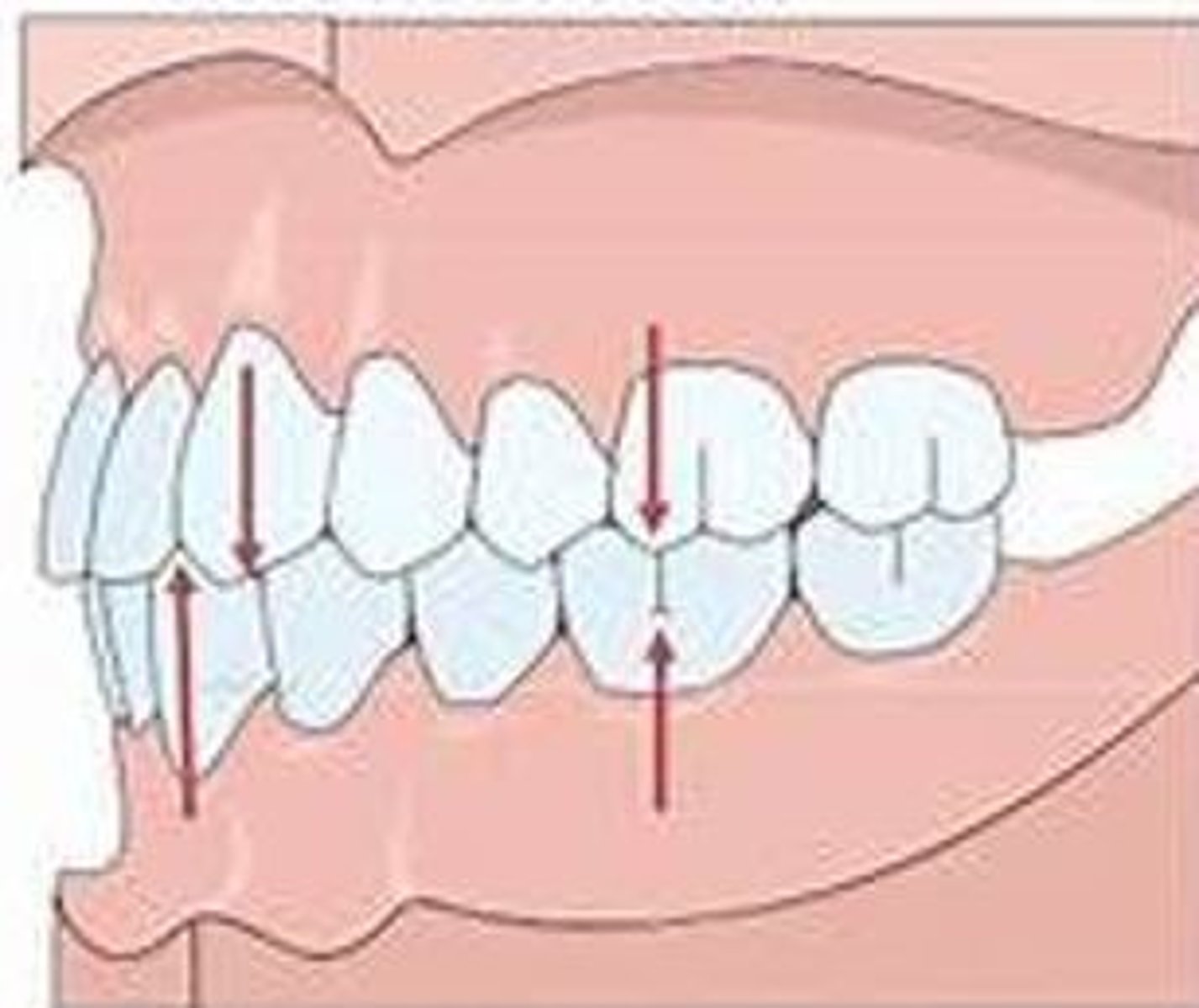 <p>When the mesiobuccal cusp of the maxillary first molar occludes with the mesiobuccal groove of the mandibular first molar it is called Angle Class ___ occlusion.</p>