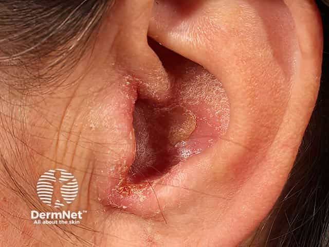 <p>aka swimmers ear</p><p>drainage from the external auditory canal, pain, fever, swelling of the pinna</p><p>bacterial or fungal infection caused by humid environment, skin condition, or abrasion</p><p>Treatment: prescribed drops</p>