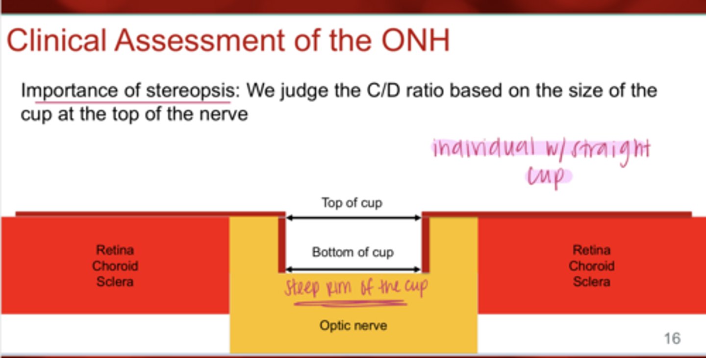<p>REVIEW: What is the importance of stereopsis in the clinical assessment of the ONH?</p>