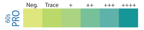 <p>The protein and glucose on reagent strips are examples of what analysis? ( 1+, 2+. +/- )</p>