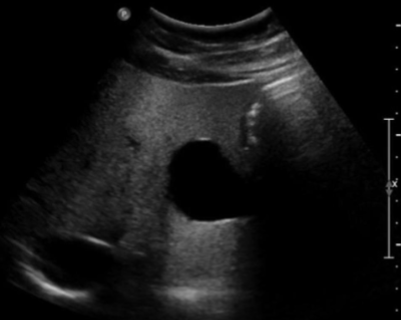 <ul><li><p><span style="background-color: transparent;">Caused by a structure of low attenuation adjacent to a structure of normal attenuation</span></p></li></ul><ul><li><p><span style="background-color: transparent;">Appears as a band of increased echogenicity behind an area of low attenuation</span></p></li><li><p><span style="background-color: transparent;">Reduced by:</span></p><ul><li><p><span style="background-color: transparent;">Gain & TGCs</span></p></li><li><p><span style="background-color: transparent;">Spatial compounding</span></p></li></ul></li><li><p><span style="background-color: transparent;">Can be diagnostically useful to distinguish fluid-filled from solid objects</span></p><ul><li><p><span style="background-color: transparent;">Fluid filled objects have this artifact</span></p></li><li><p><span style="background-color: transparent;">Solid objects DO NOT have this artifact</span></p></li></ul></li></ul><p></p>